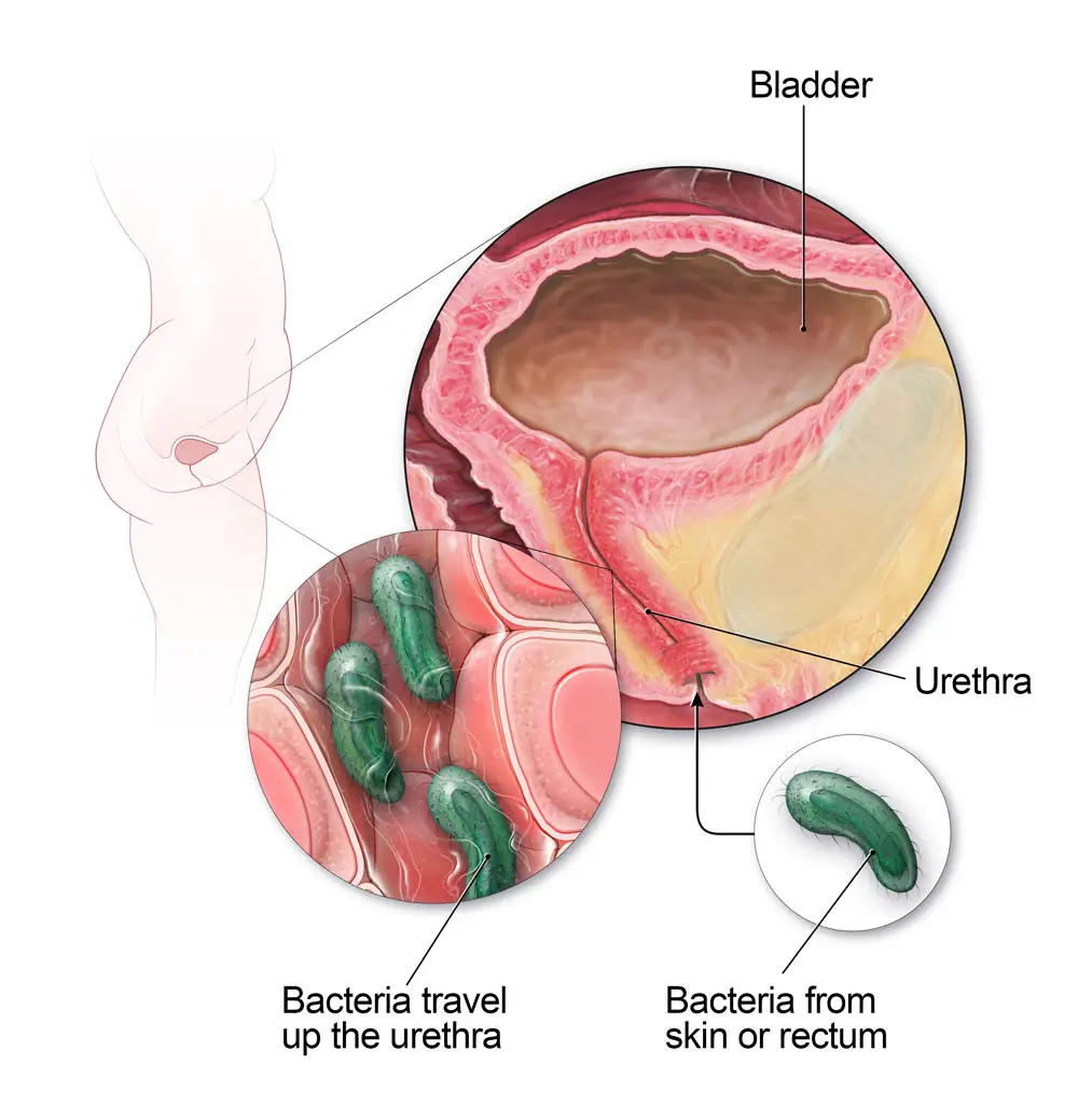 Urinary Tract Infections (UTIs) 2 Uti 2